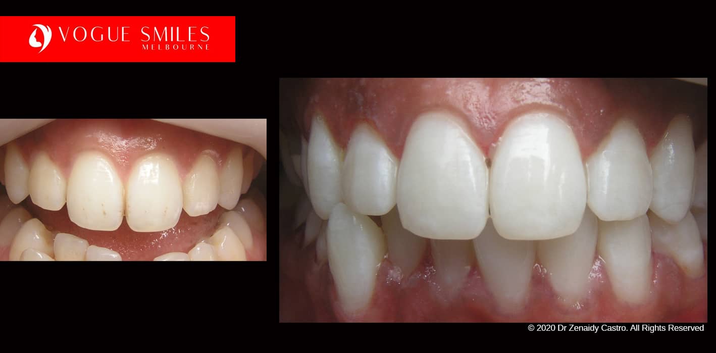 At-Home Teeth Whitening: Full DIY Guide, Tips & SPECIALS