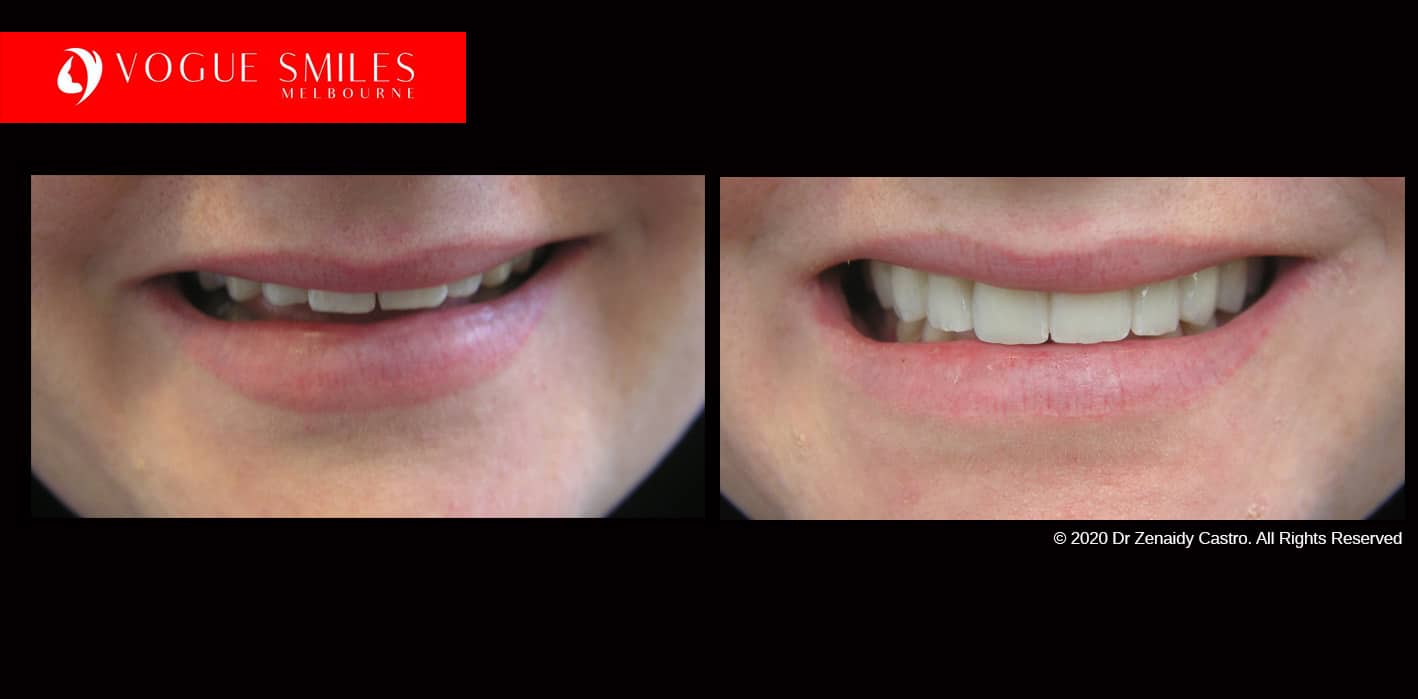 Full-Mouth-Reconstruction-complete-extreme-dental-makeover