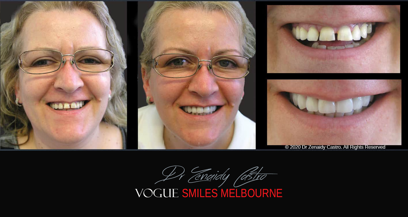 Close Gaps or Spacing Between Teeth Noble Park Dentist - Cosmetic Dental Clinic