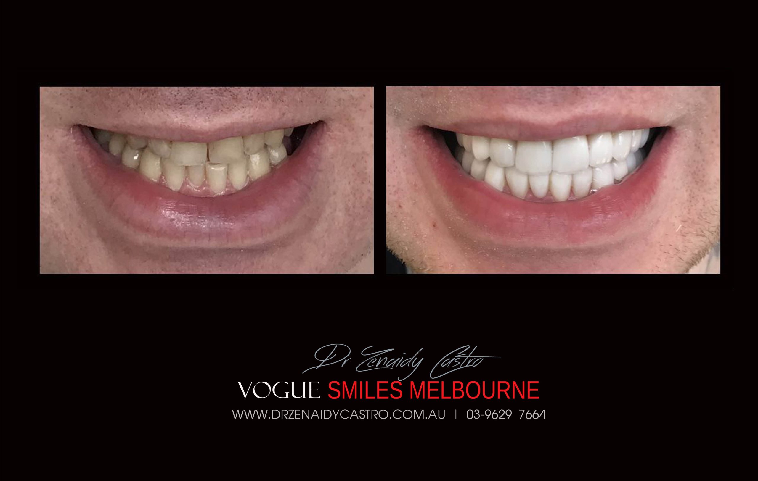 NARROW-SMILES-BROADENING-SMILES