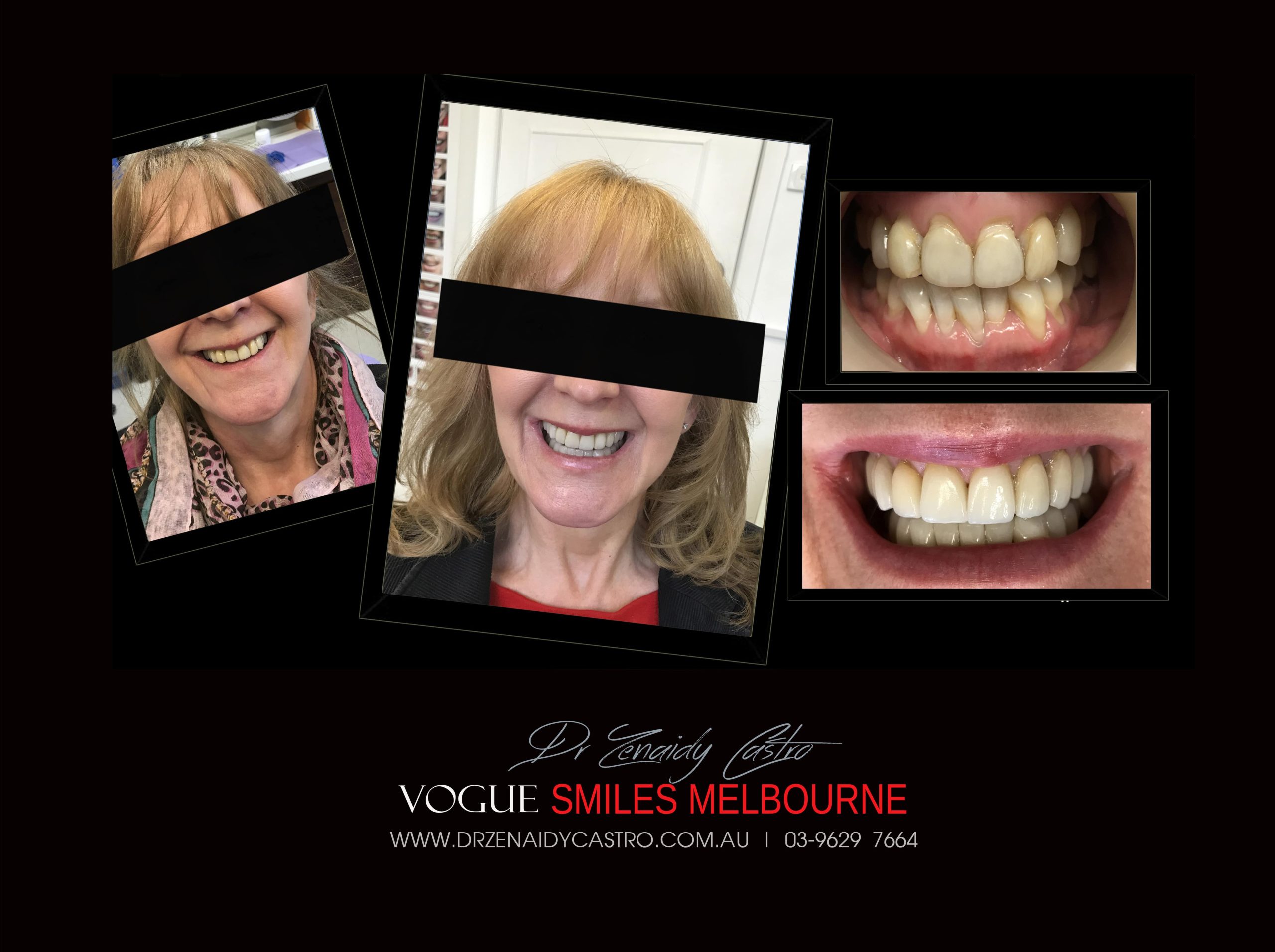 NARROW-SMILES-BROADENING-SMILES