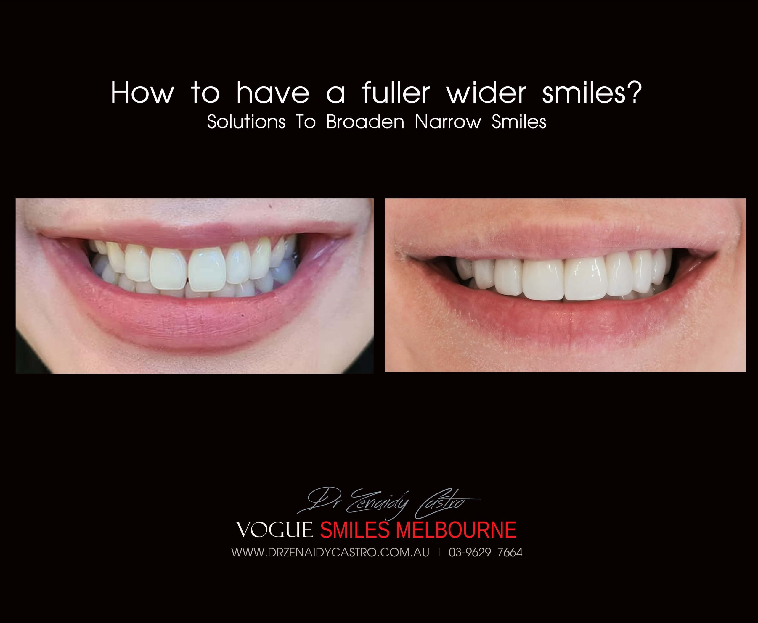 NARROW-SMILES-BROADENING-SMILES