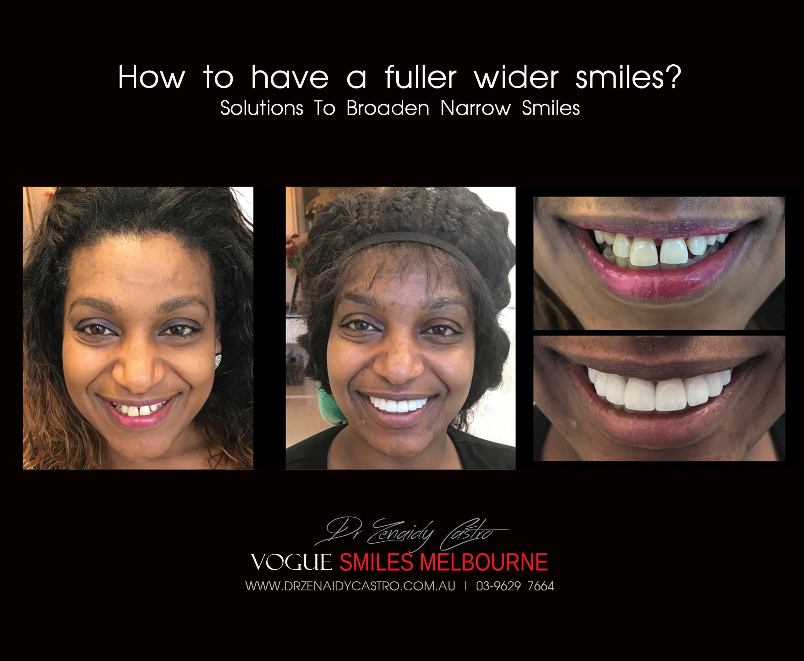 NARROW-SMILES-BROADENING-SMILES