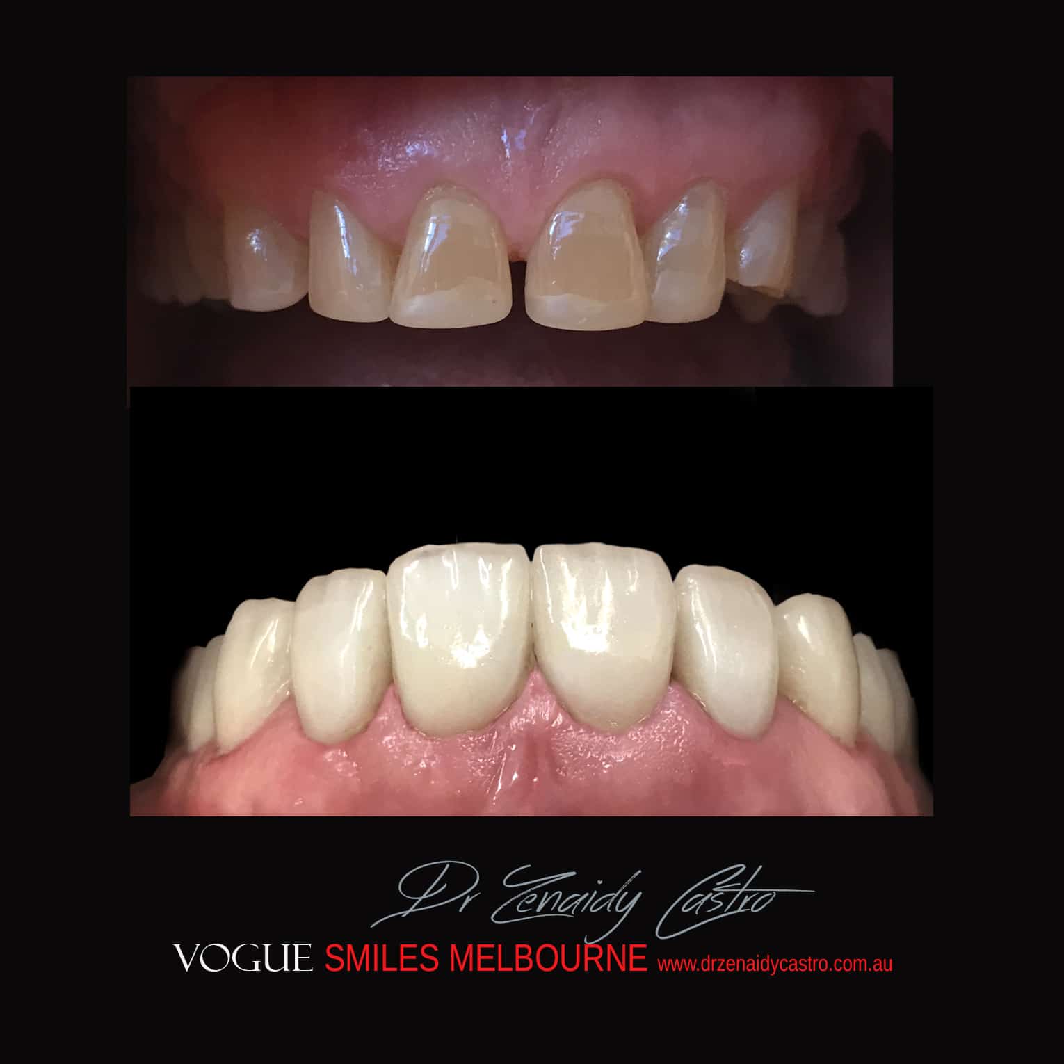 NARROW-SMILES-BROADENING-SMILES