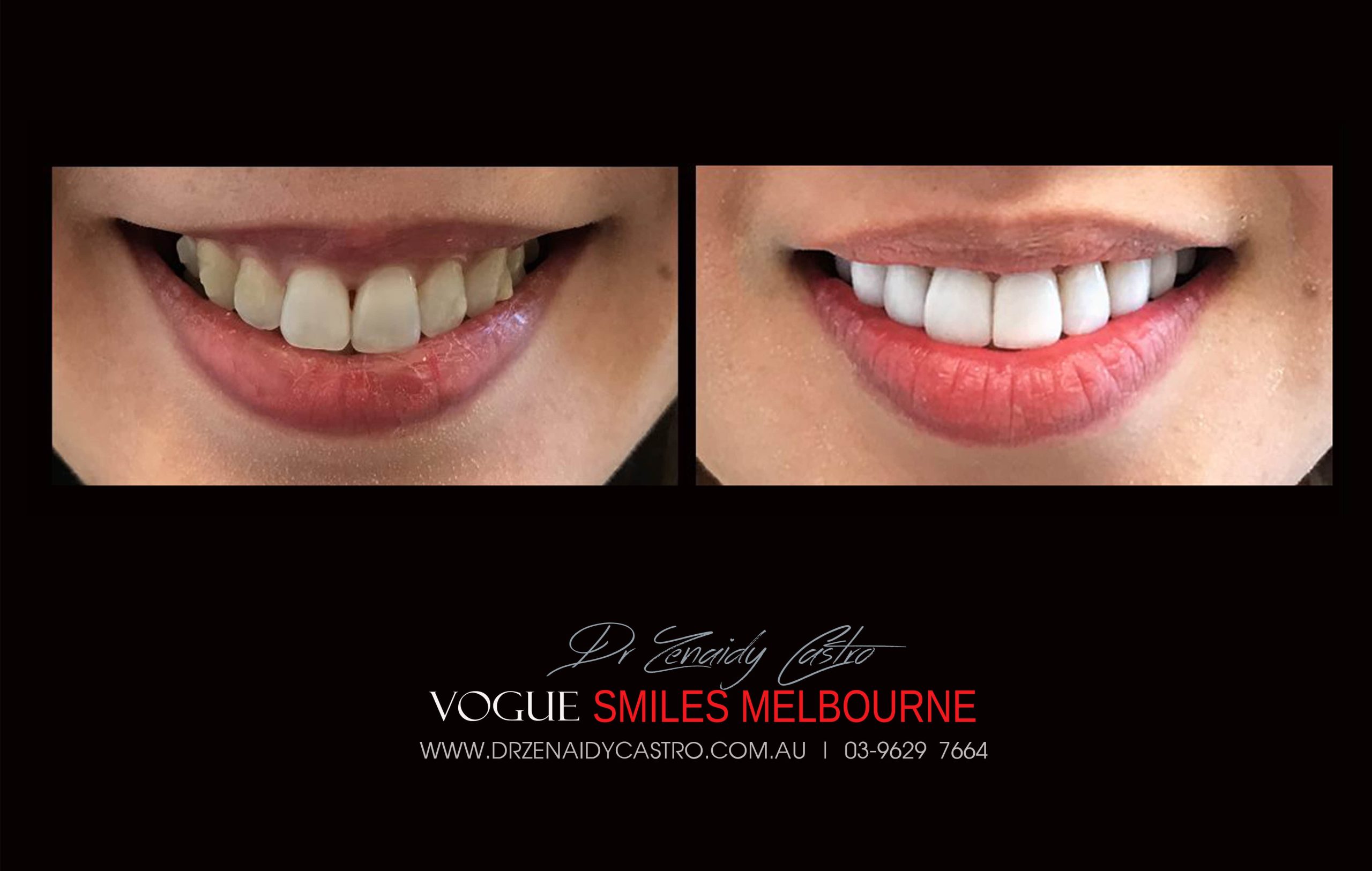 NARROW-SMILES-BROADENING-SMILES