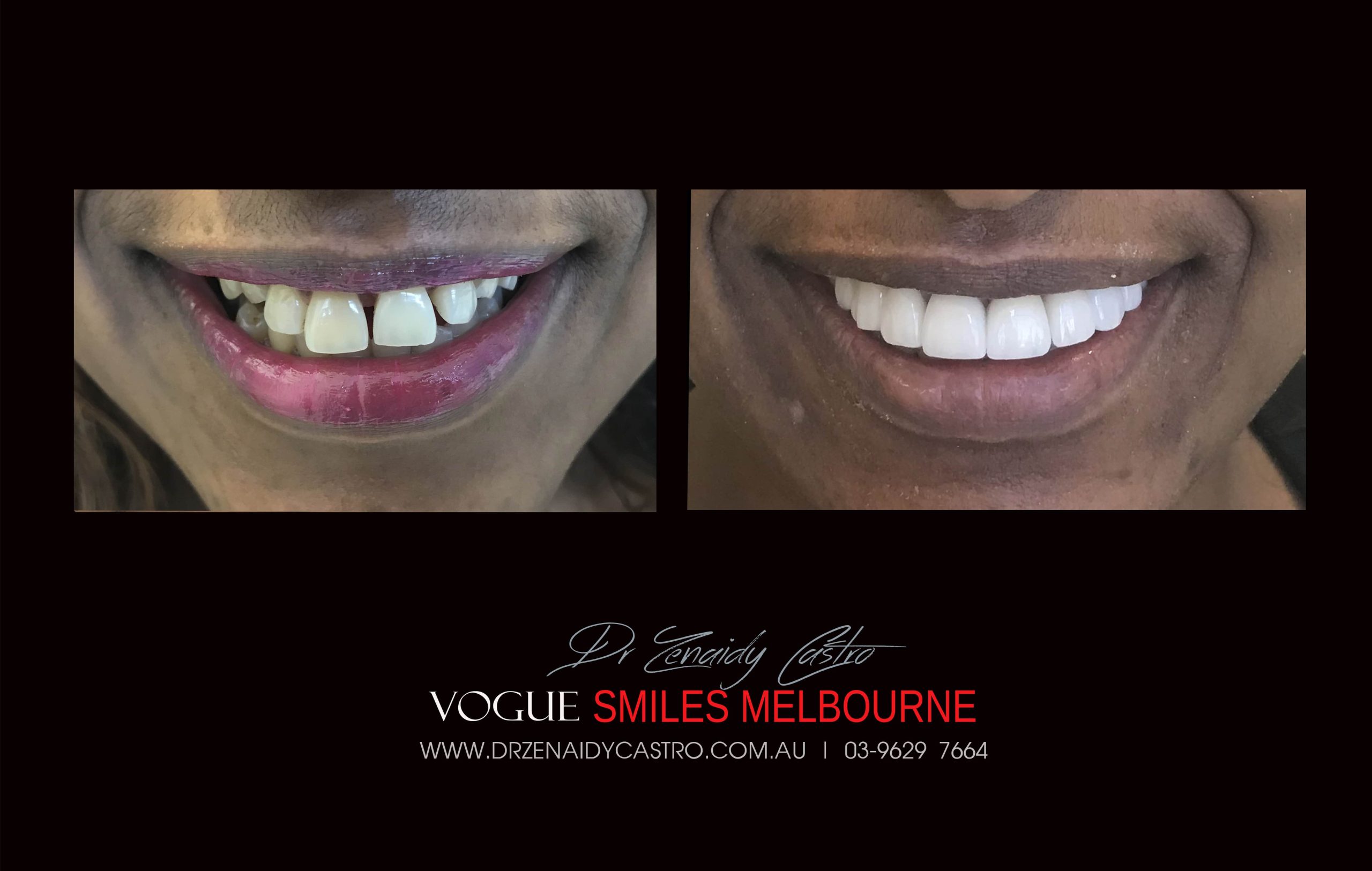 NARROW-SMILES-BROADENING-SMILES