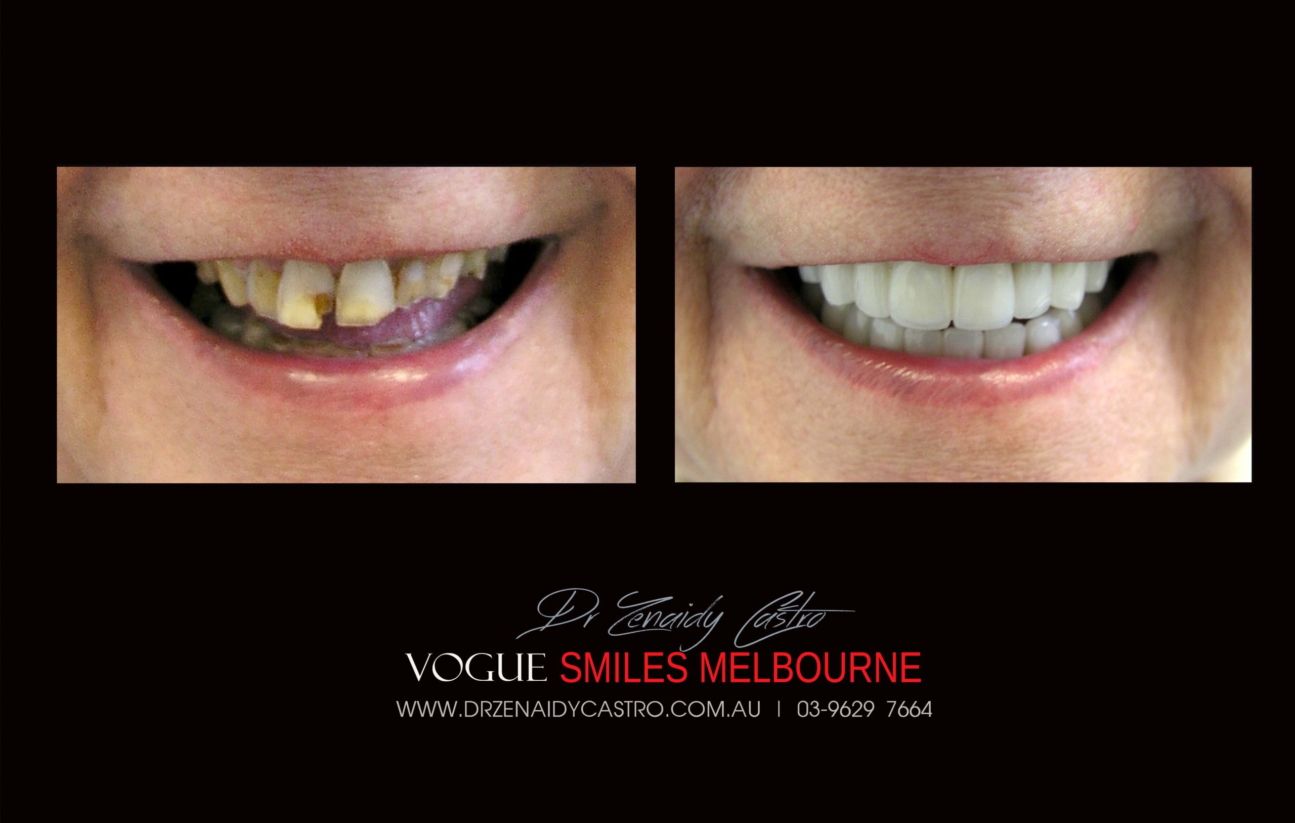 NARROW-SMILES-BROADENING-SMILES