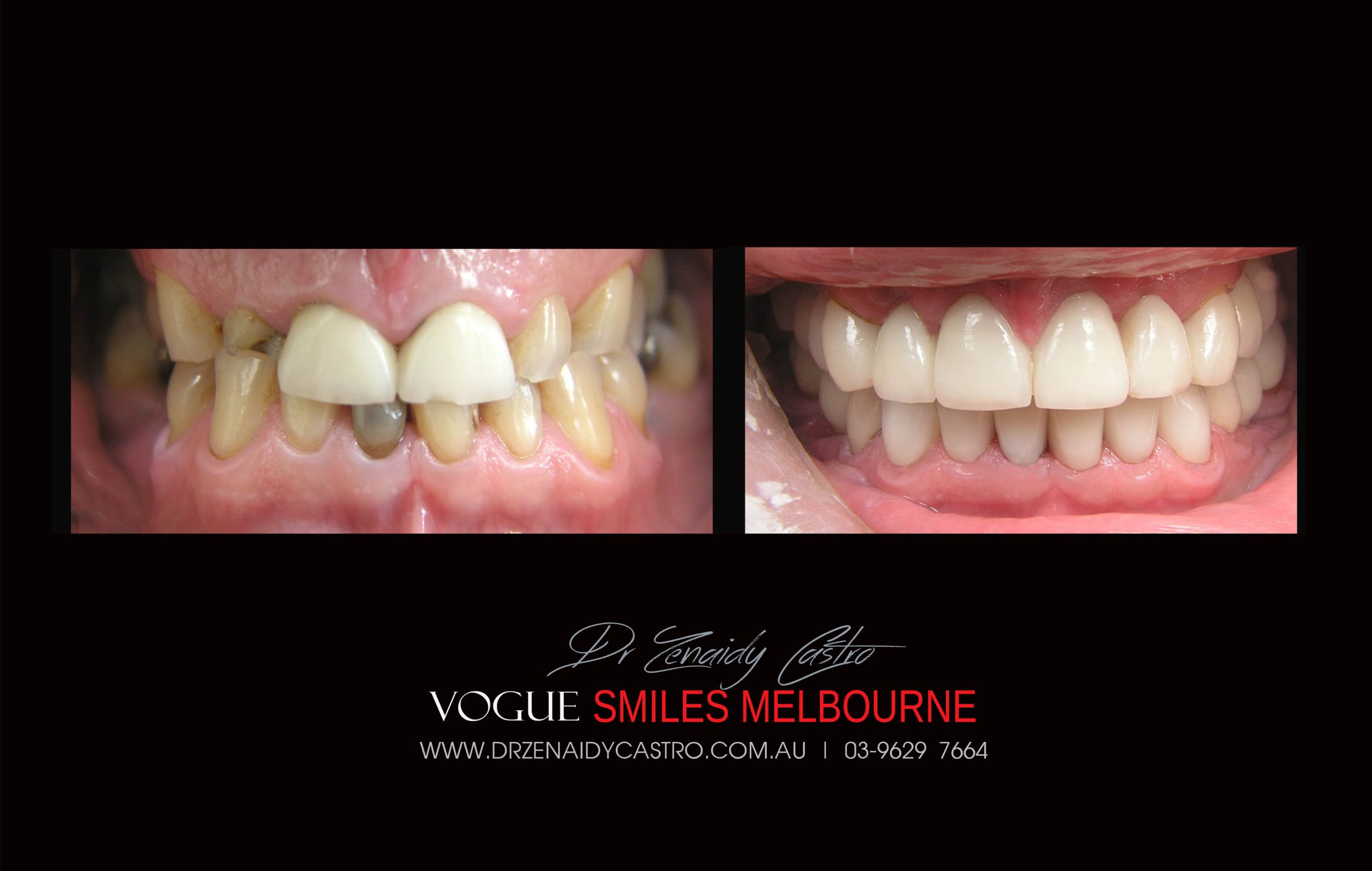 NARROW-SMILES-BROADENING-SMILES