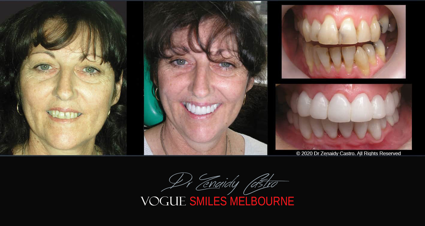 Porcelain Veneers near Wheelers Hill area - Before and After Pictures - Dental Veneers - Tooth Veneers - Top Cosmetic Dentist in Wheelers Hill