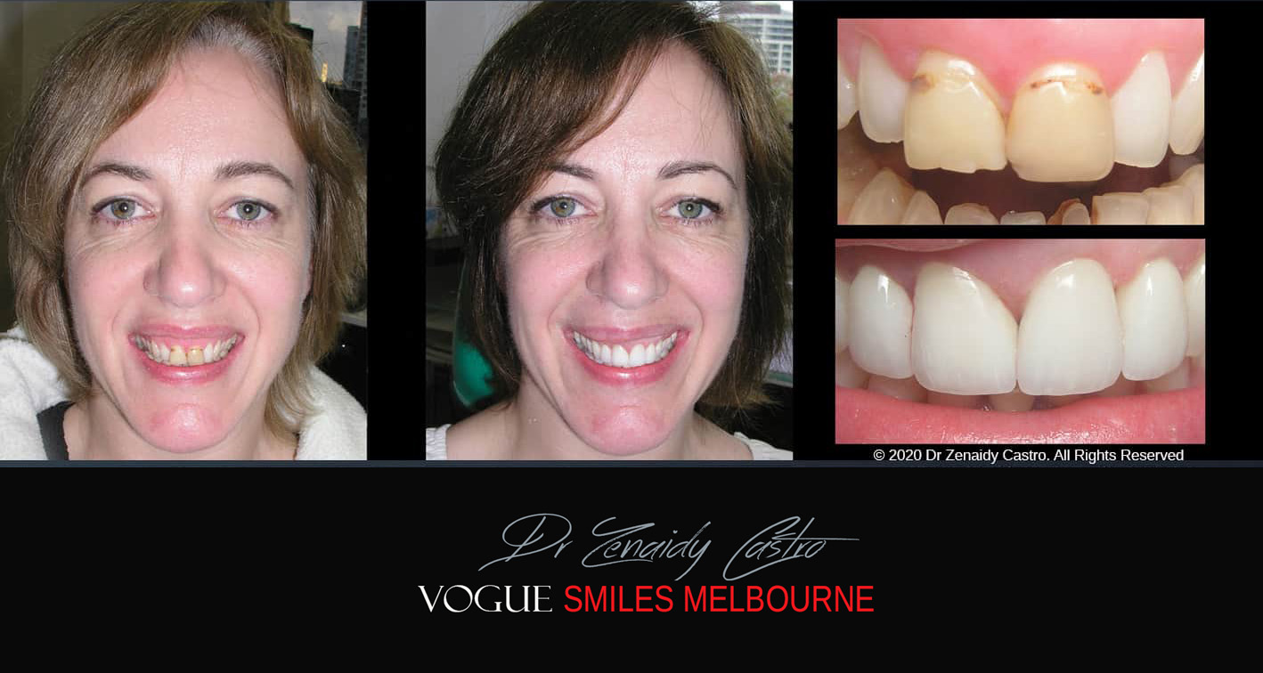 Porcelain Veneers near Wheelers Hill area - Before and After Pictures - Dental Veneers - Tooth Veneers - Top Cosmetic Dentist in Wheelers Hill
