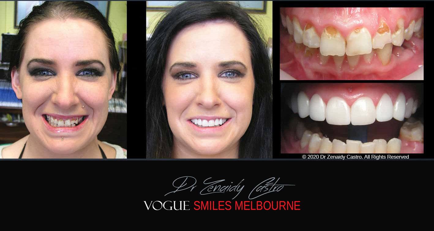 Porcelain Veneers near Wheelers Hill area - Before and After Pictures - Dental Veneers - Tooth Veneers - Top Cosmetic Dentist in Wheelers Hill