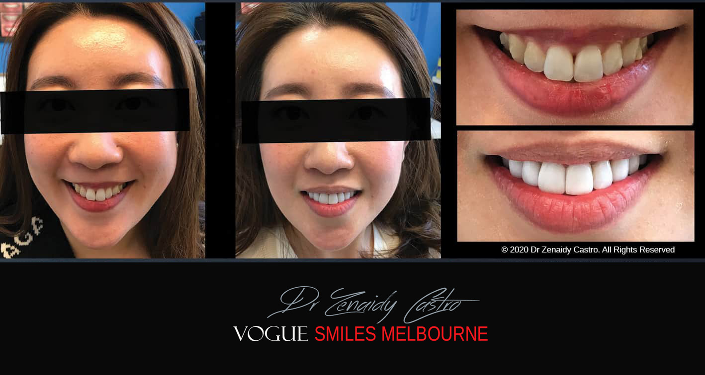 Porcelain Veneers near Wheelers Hill area - Before and After Pictures - Dental Veneers - Tooth Veneers - Top Cosmetic Dentist in Wheelers Hill
