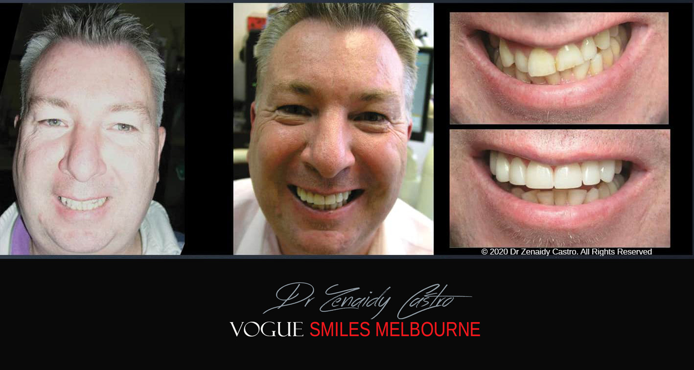 Porcelain Veneers near Wheelers Hill area - Before and After Pictures - Dental Veneers - Tooth Veneers - Top Cosmetic Dentist in Wheelers Hill