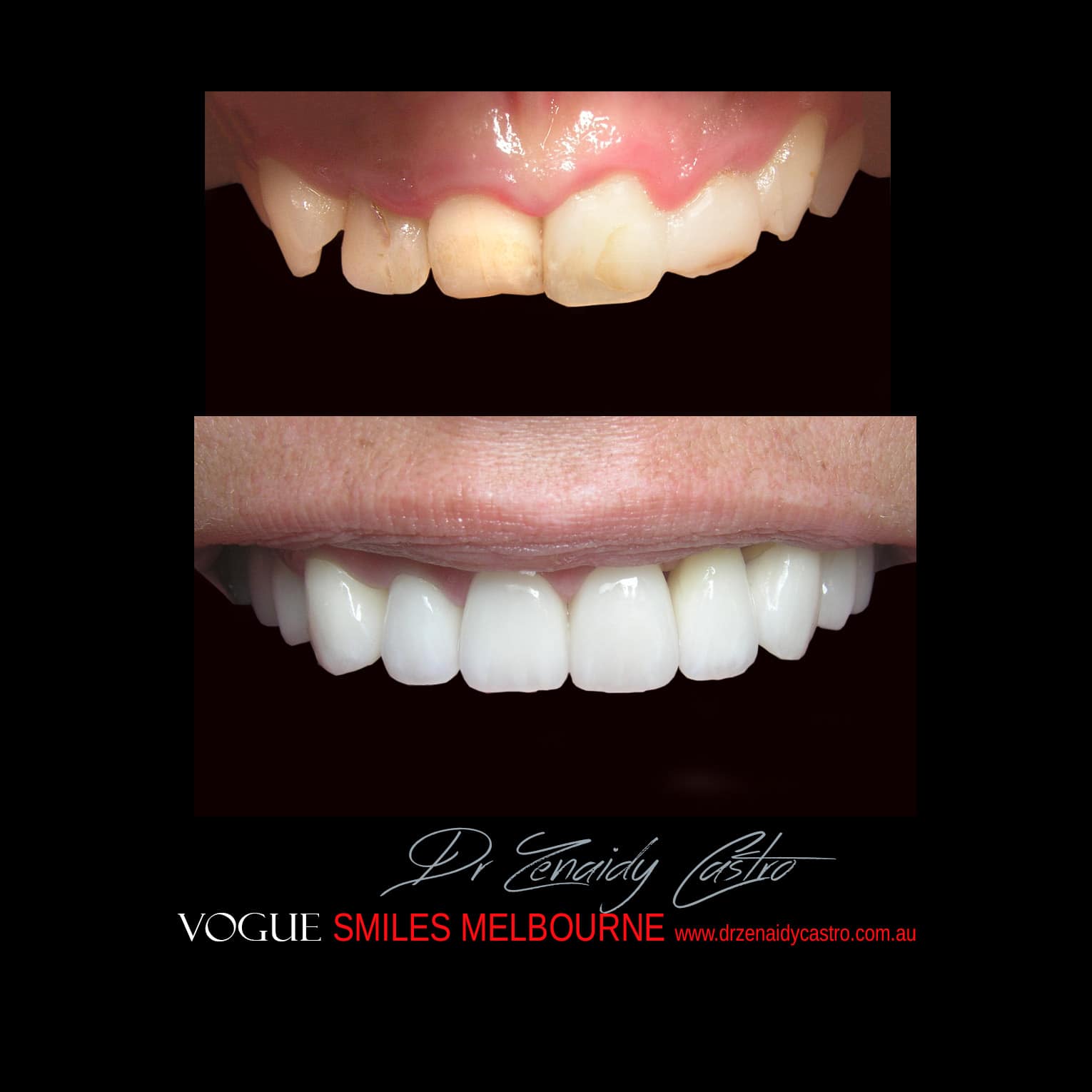 Prepless-No-Grinding-Lumineers-Porcelain-Veneers