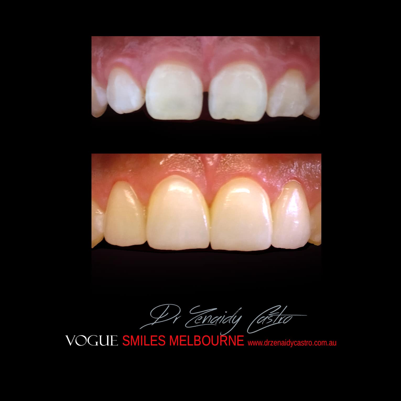 Prepless-No-Grinding-Lumineers-Porcelain-Veneers