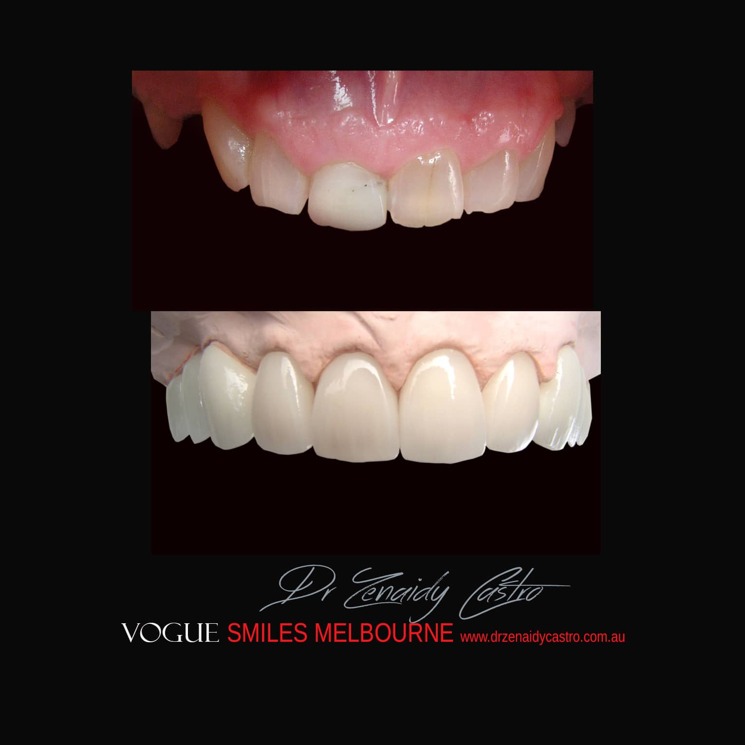 Prepless-No-Grinding-Lumineers-Porcelain-Veneers