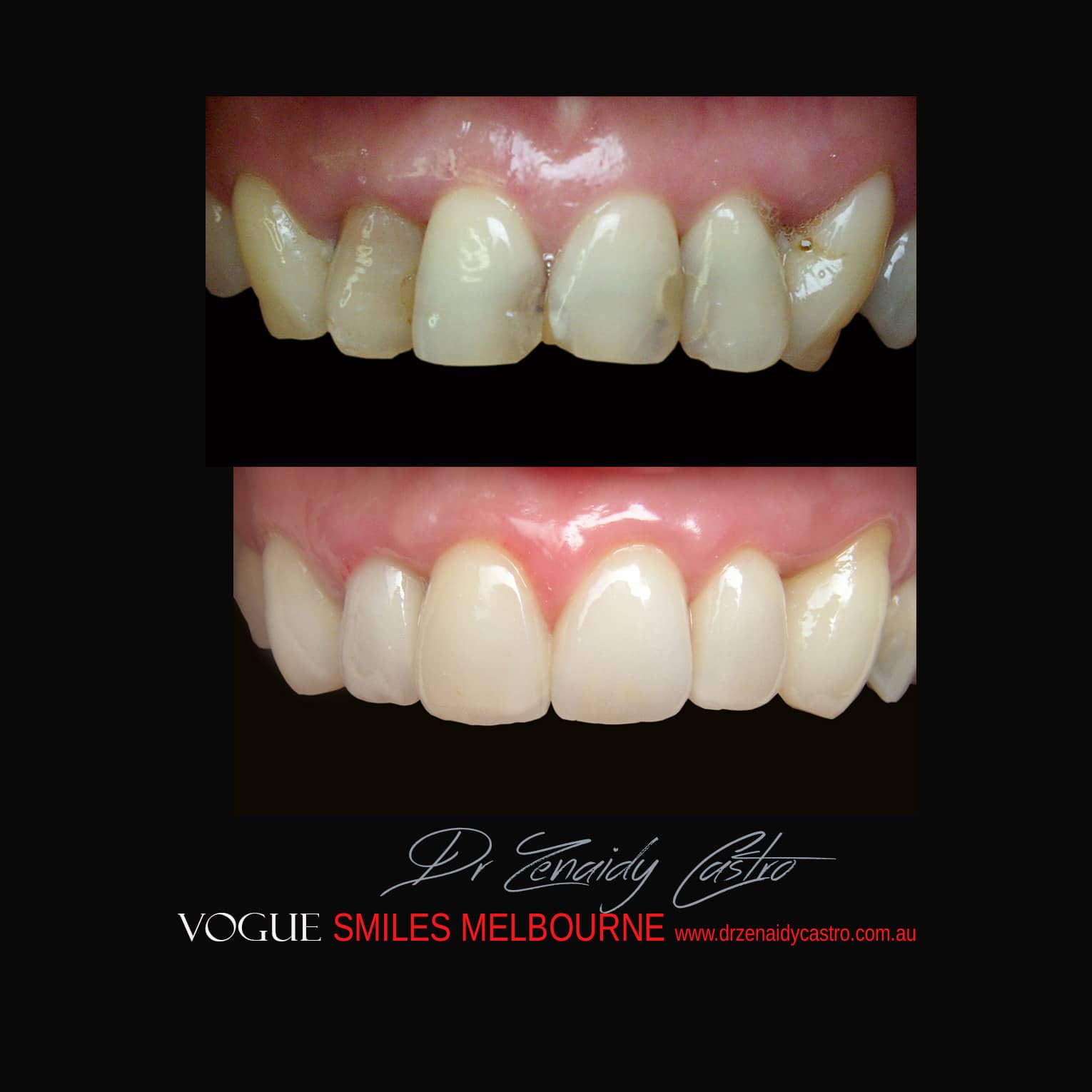 Prepless-No-Grinding-Lumineers-Porcelain-Veneers