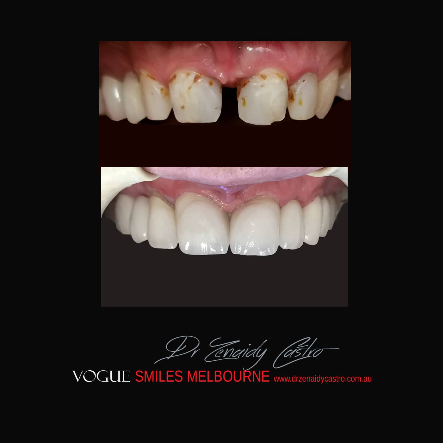 Prepless-No-Grinding-Lumineers-Porcelain-Veneers