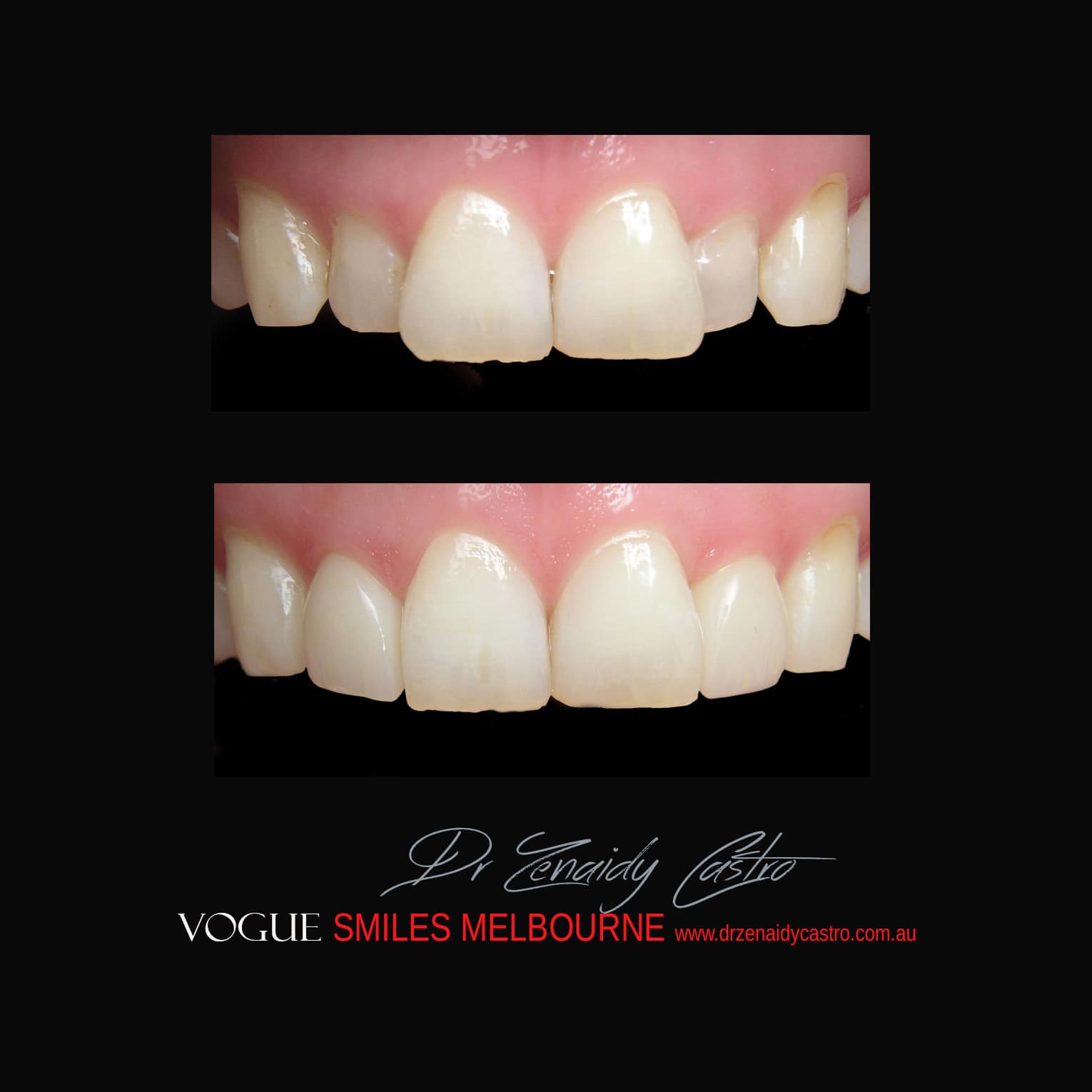 Prepless-No-Grinding-Lumineers-Porcelain-Veneers