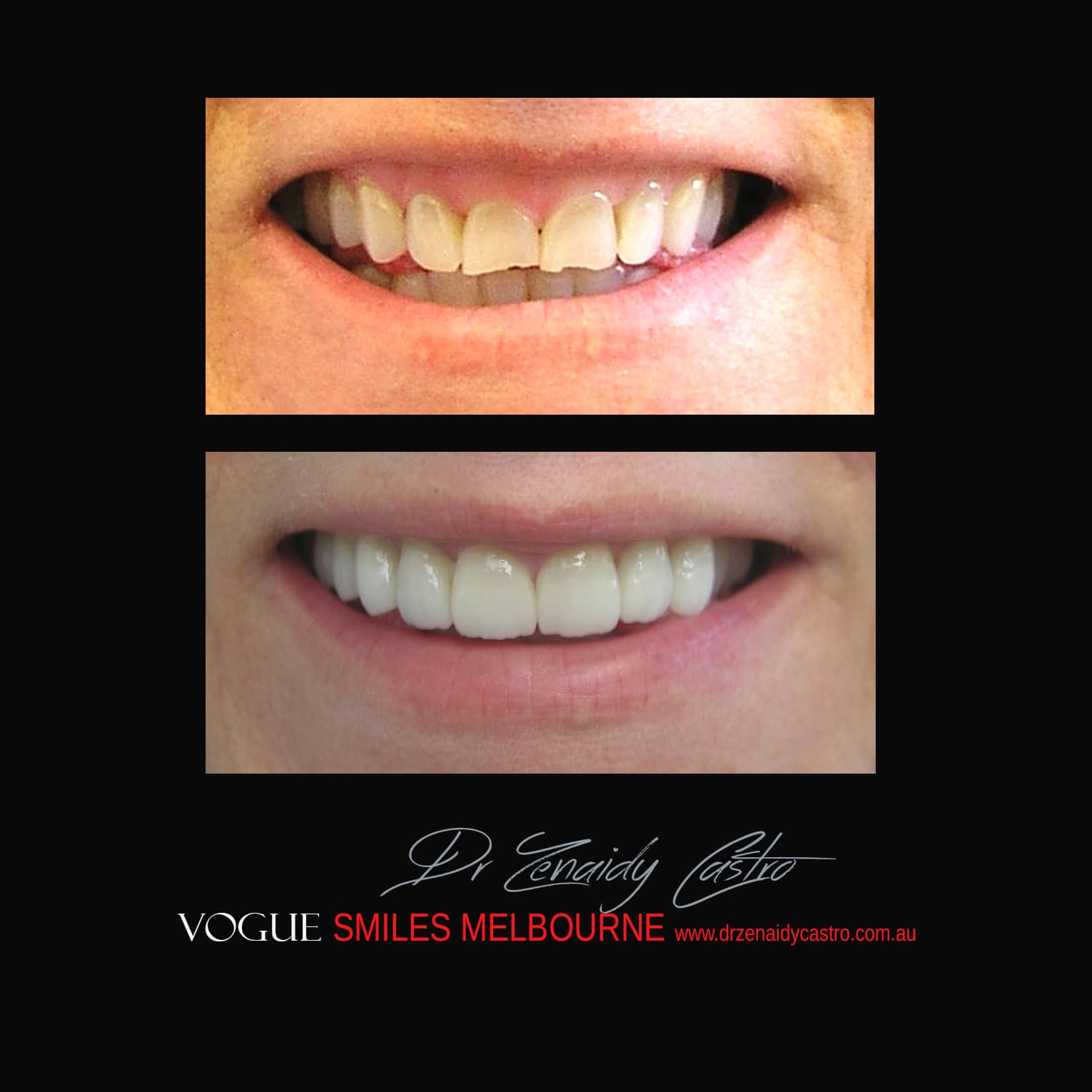 Prepless-No-Grinding-Lumineers-Porcelain-Veneers