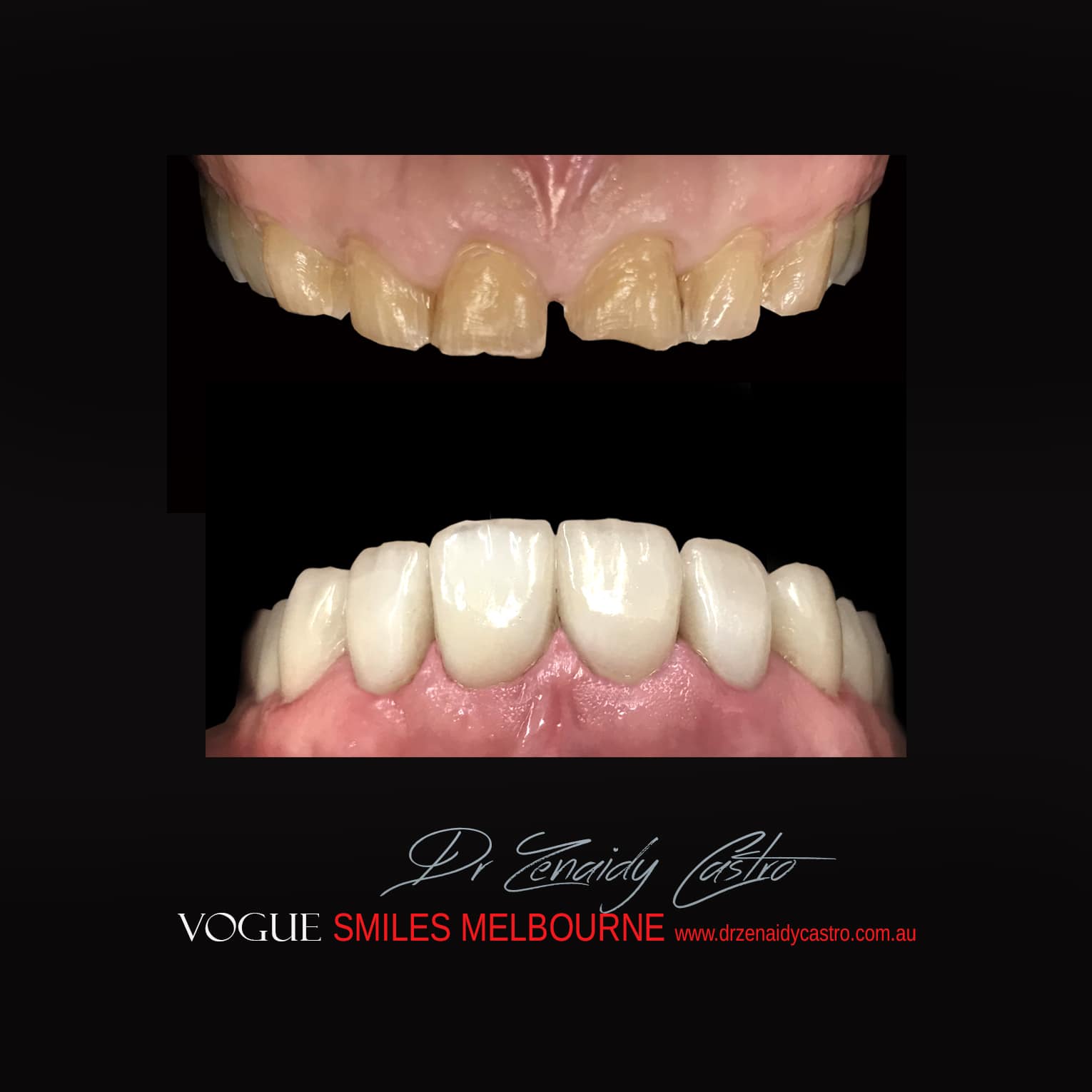 Prepless-No-Grinding-Lumineers-Porcelain-Veneers