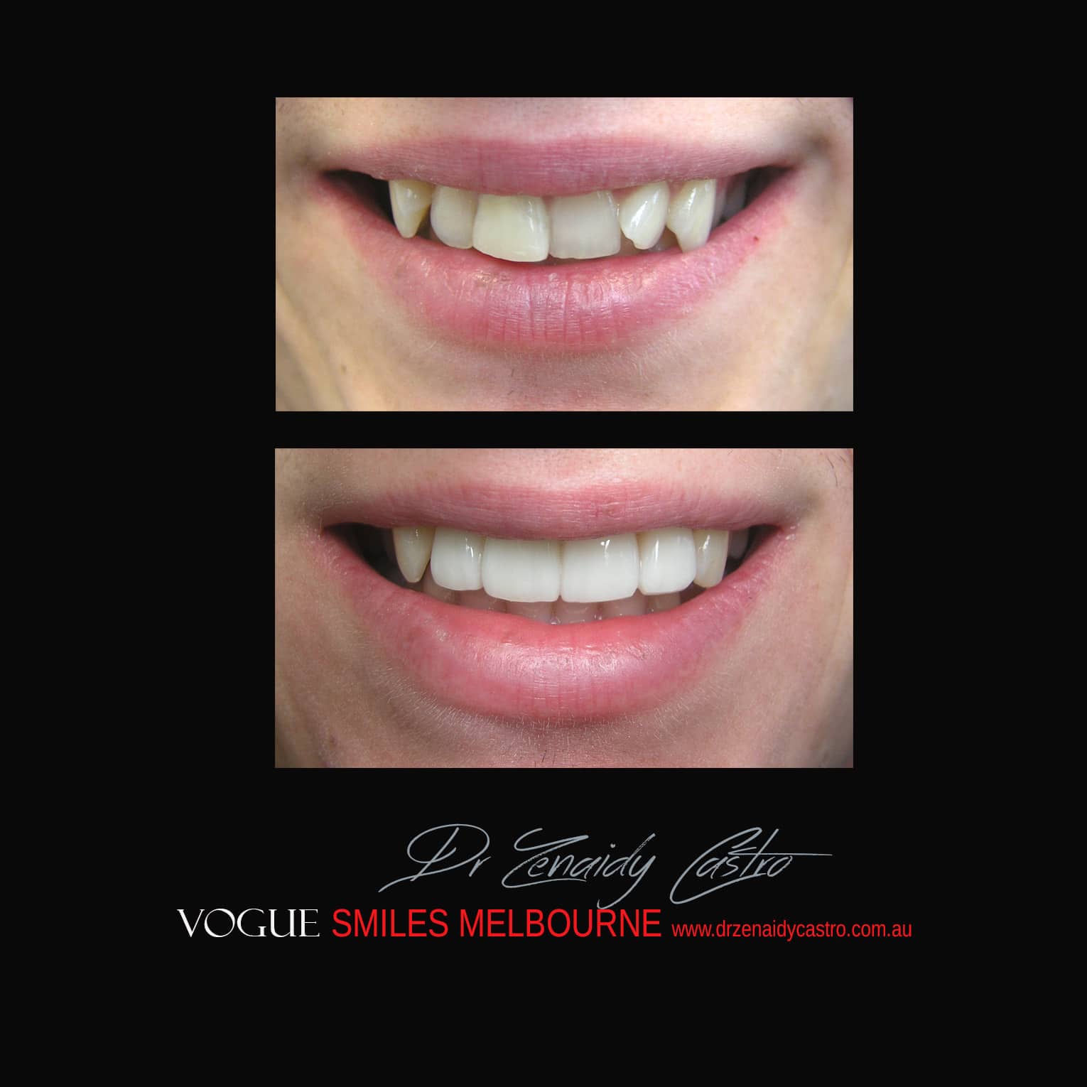 Prepless-No-Grinding-Lumineers-Porcelain-Veneers
