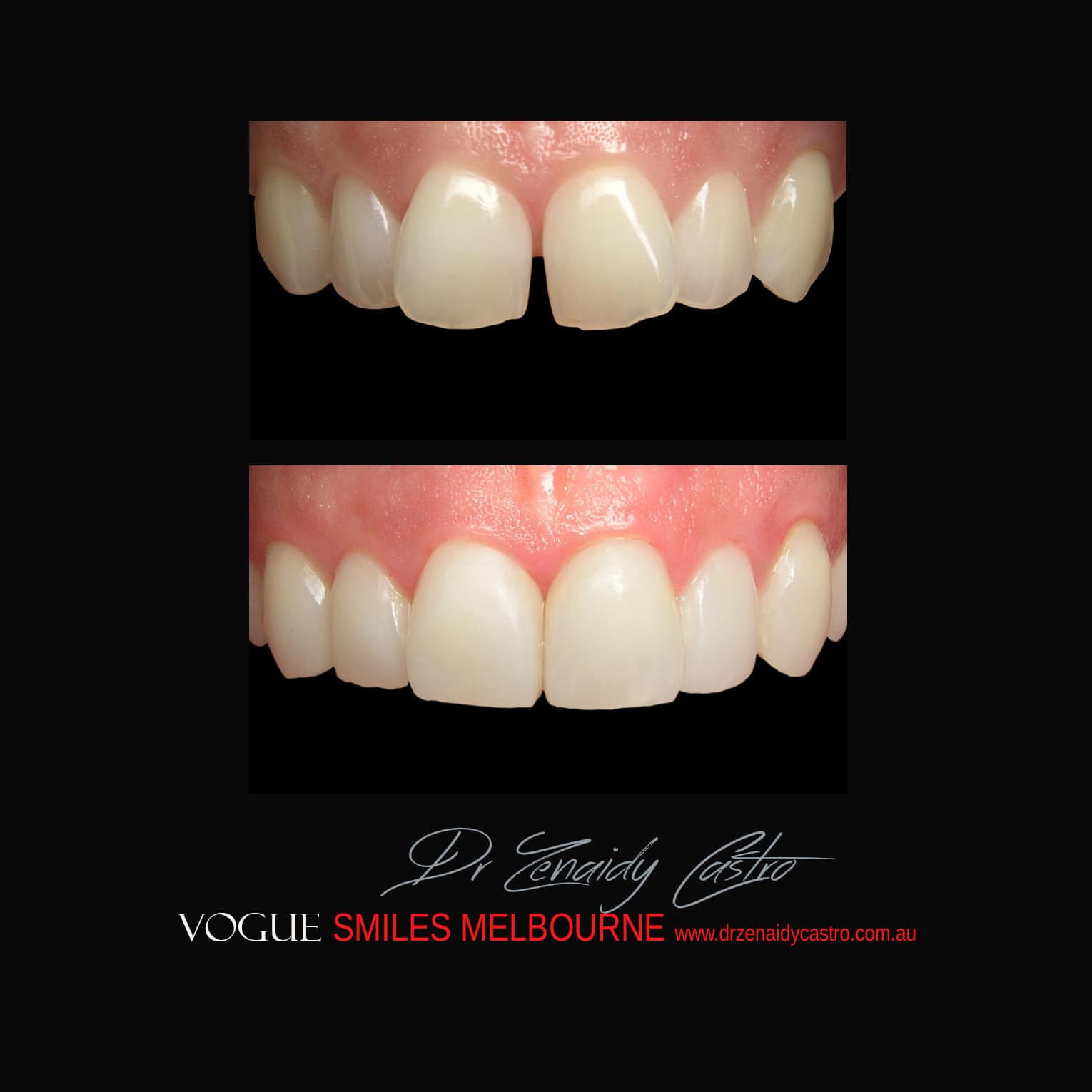 Prepless-No-Grinding-Lumineers-Porcelain-Veneers