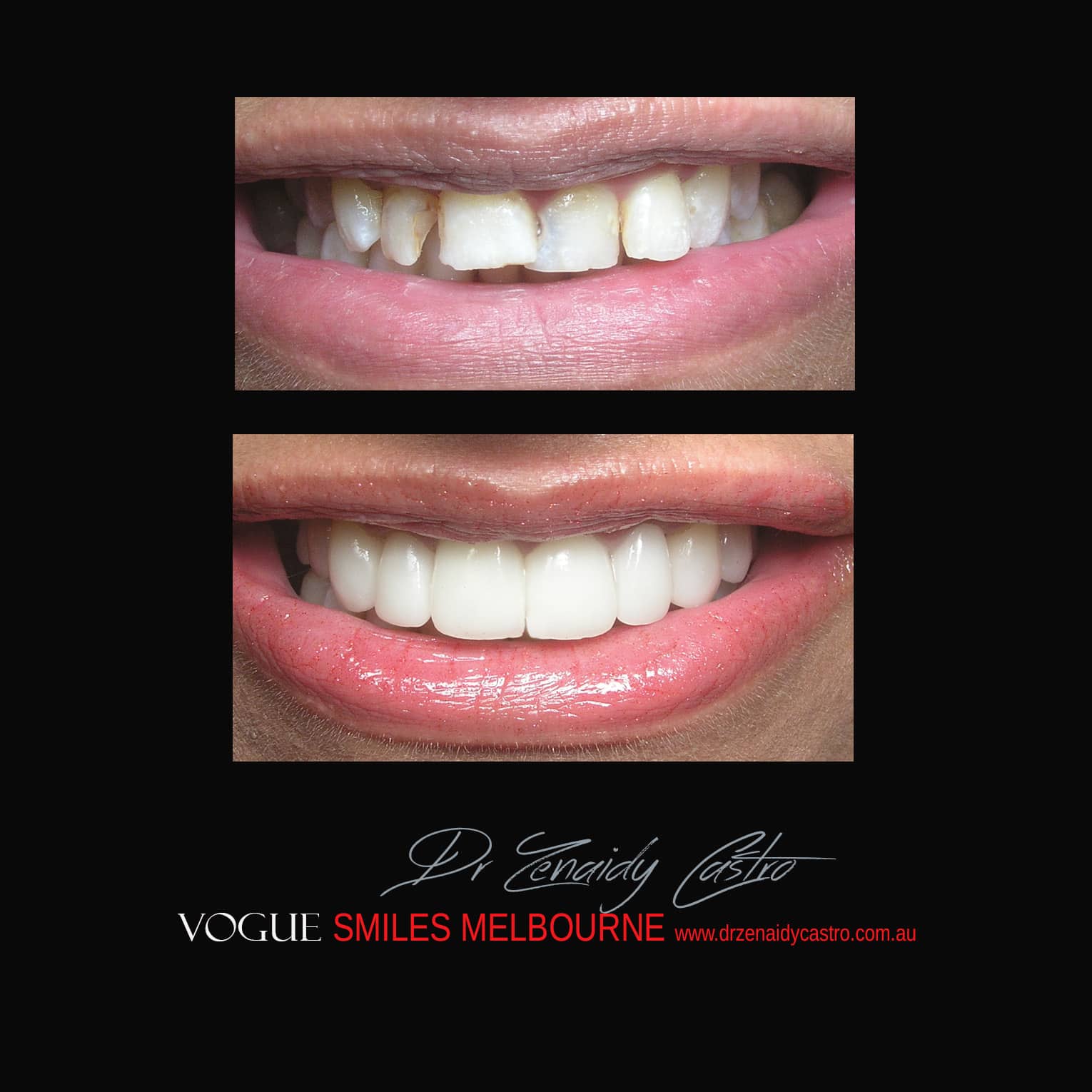 Prepless-No-Grinding-Lumineers-Porcelain-Veneers