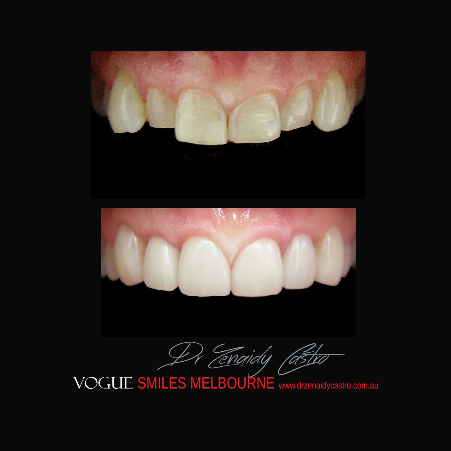 Prepless-No-Grinding-Lumineers-Porcelain-Veneers