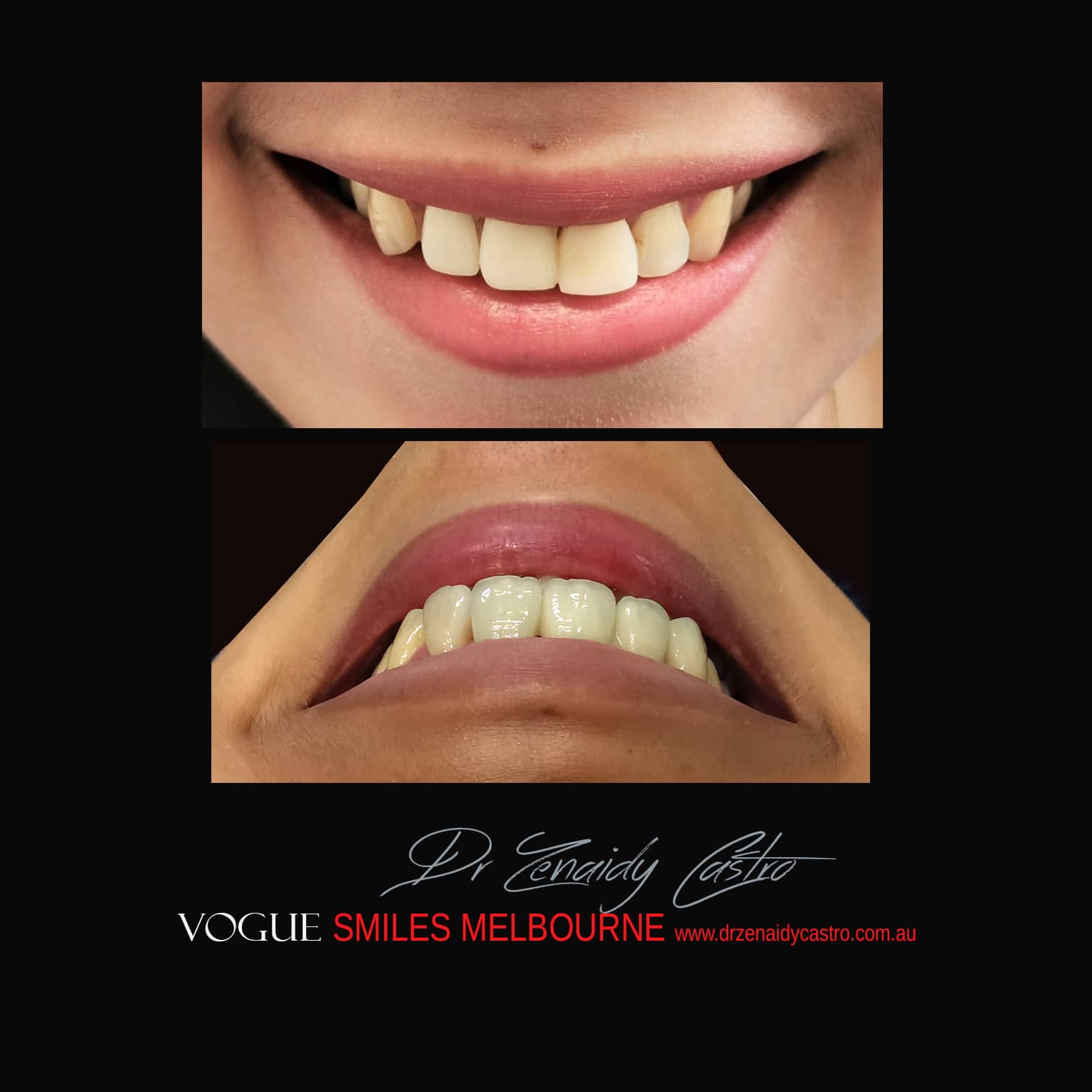 Prepless-No-Grinding-Lumineers-Porcelain-Veneers