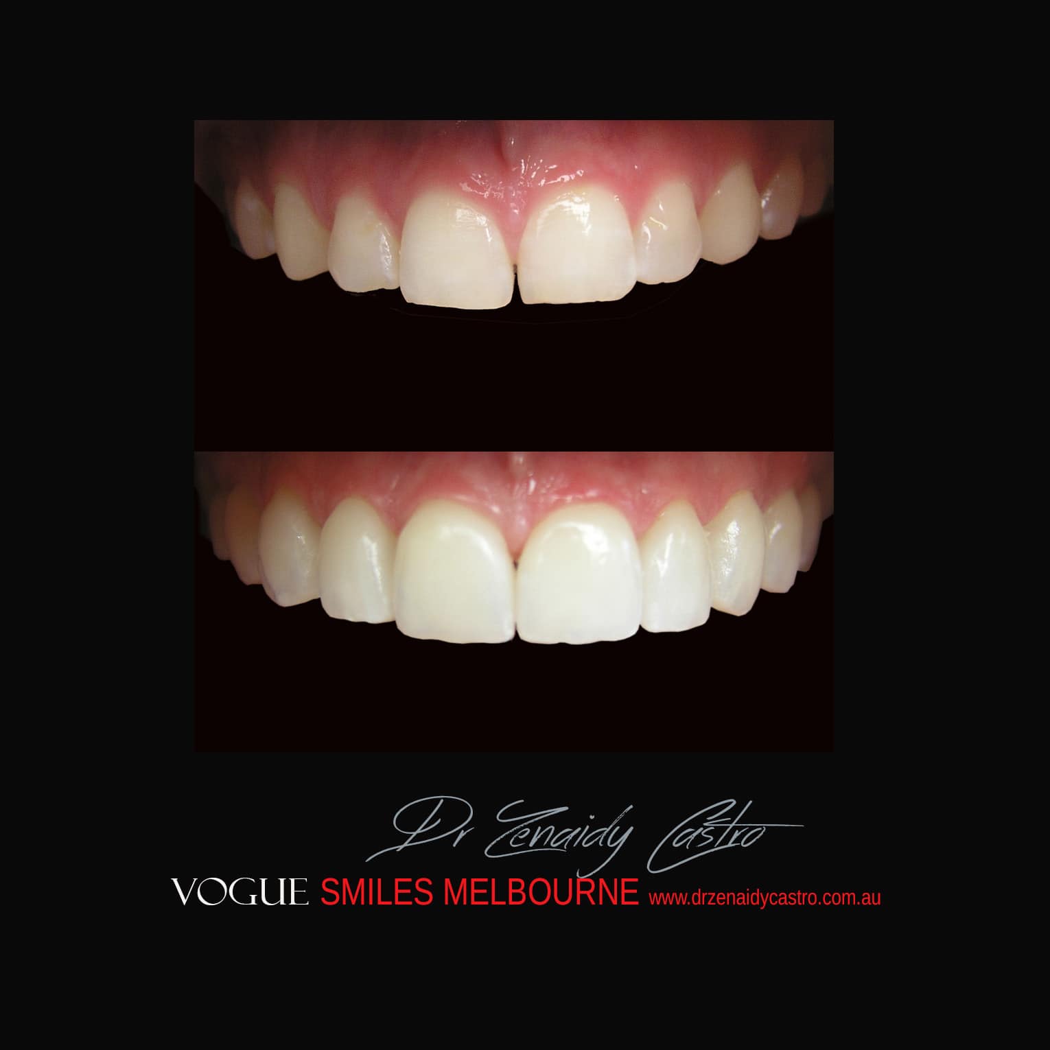 Prepless-No-Grinding-Lumineers-Porcelain-Veneers