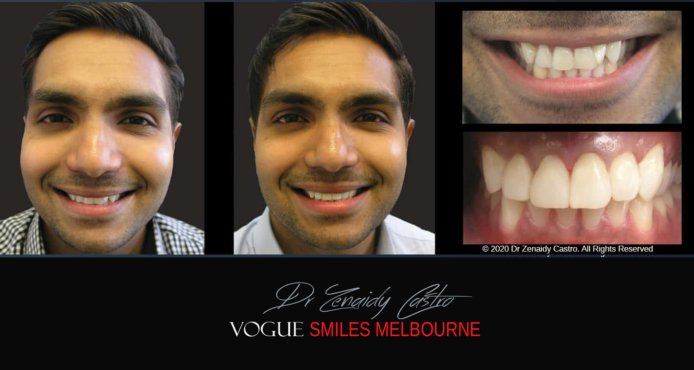 Fix Crooked Teeth - Instant Teeth Straightening with Porcelain Veneers -Family Cosmetic Dental Practice - Noble Park North Dentist