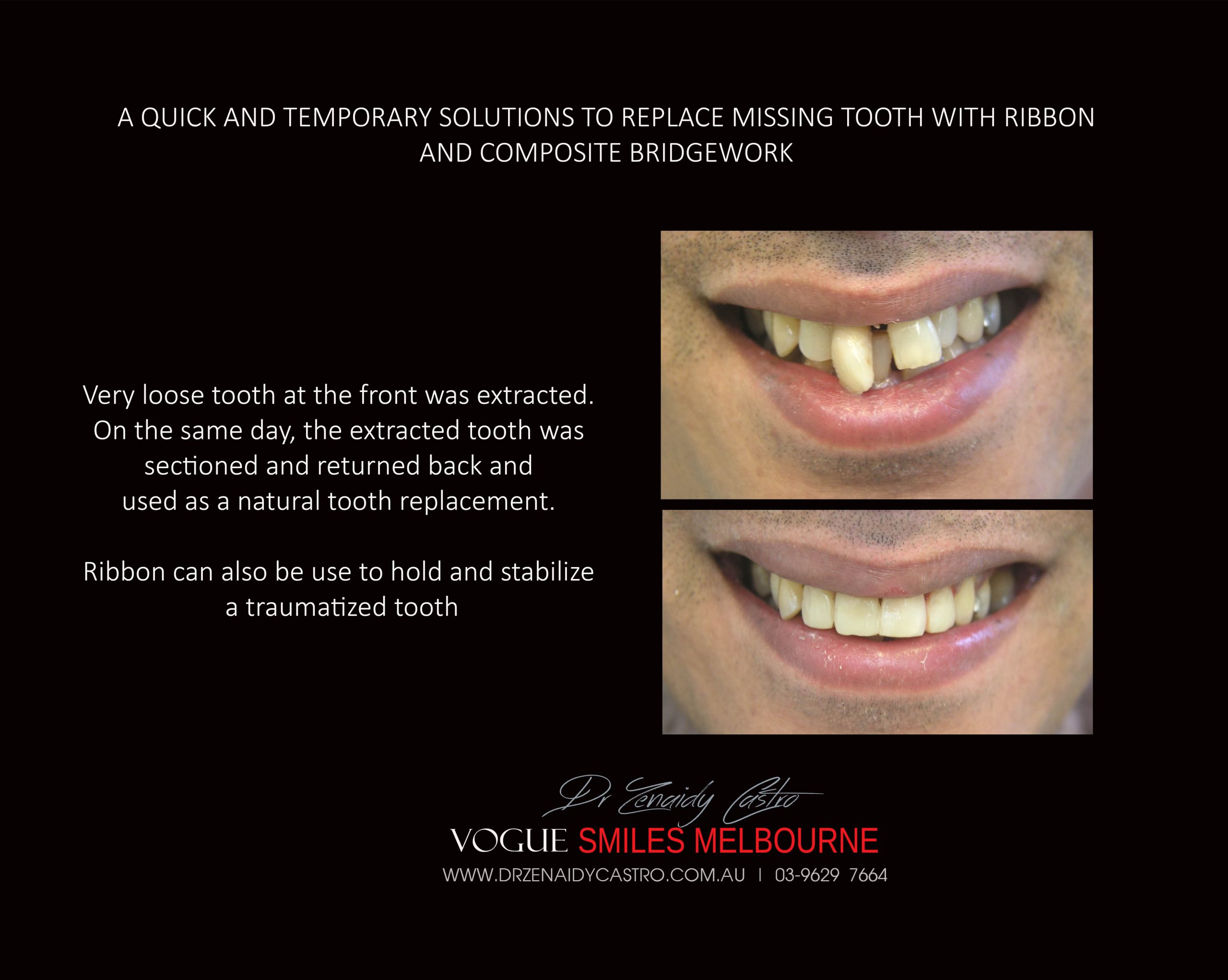 TRANSITIONAL-MAKEOVERS-Cheap-Smile-Makoever-Solutions