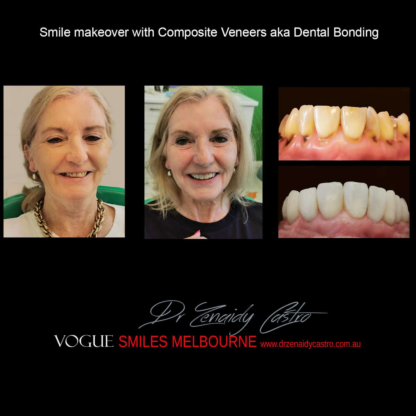TRANSITIONAL-MAKEOVERS-Cheap-Smile-Makoever-Solutions