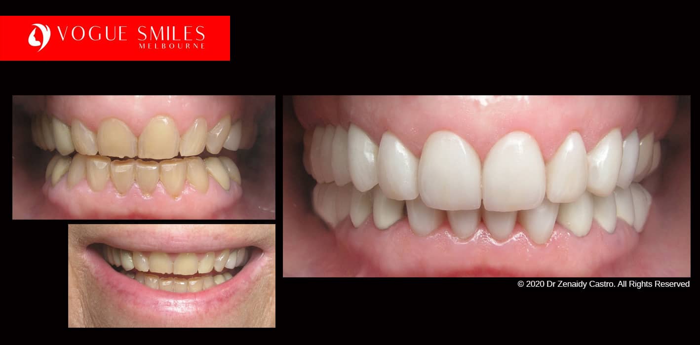 Teeth-Whitening-Before-and-After-Melbourne-CBD-Noble-