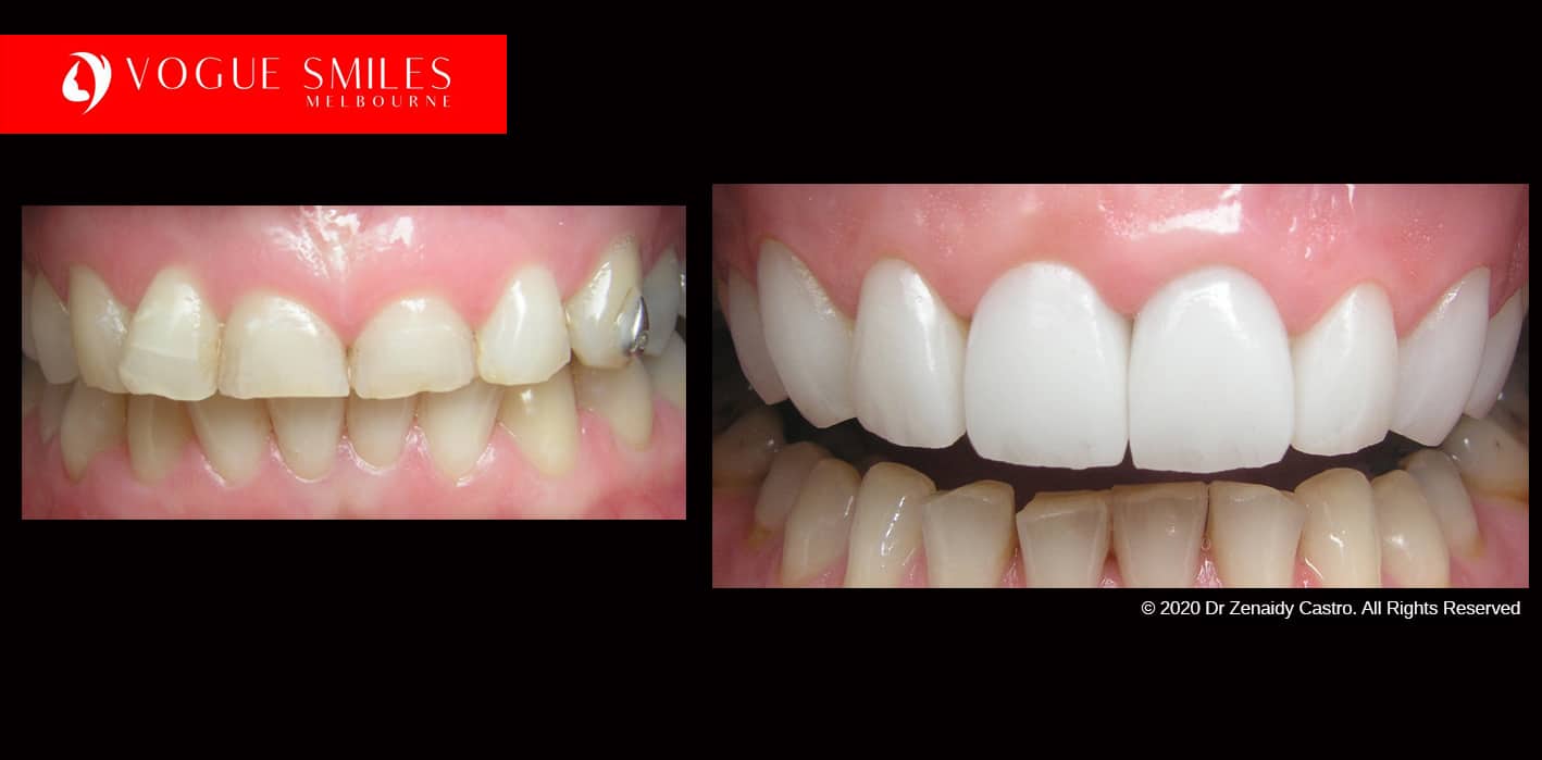 Teeth-Whitening-Before-and-After-Melbourne-CBD-Noble-