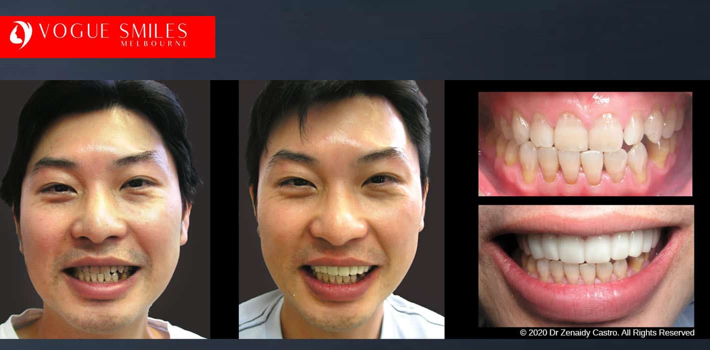 Teeth-Whitening-Before-and-After-Melbourne-CBD-Noble-