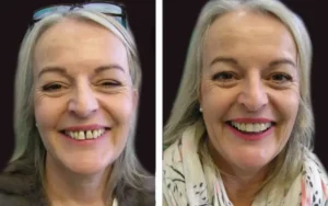 Melbourne Veneers Price Guide: Explore Budget Options