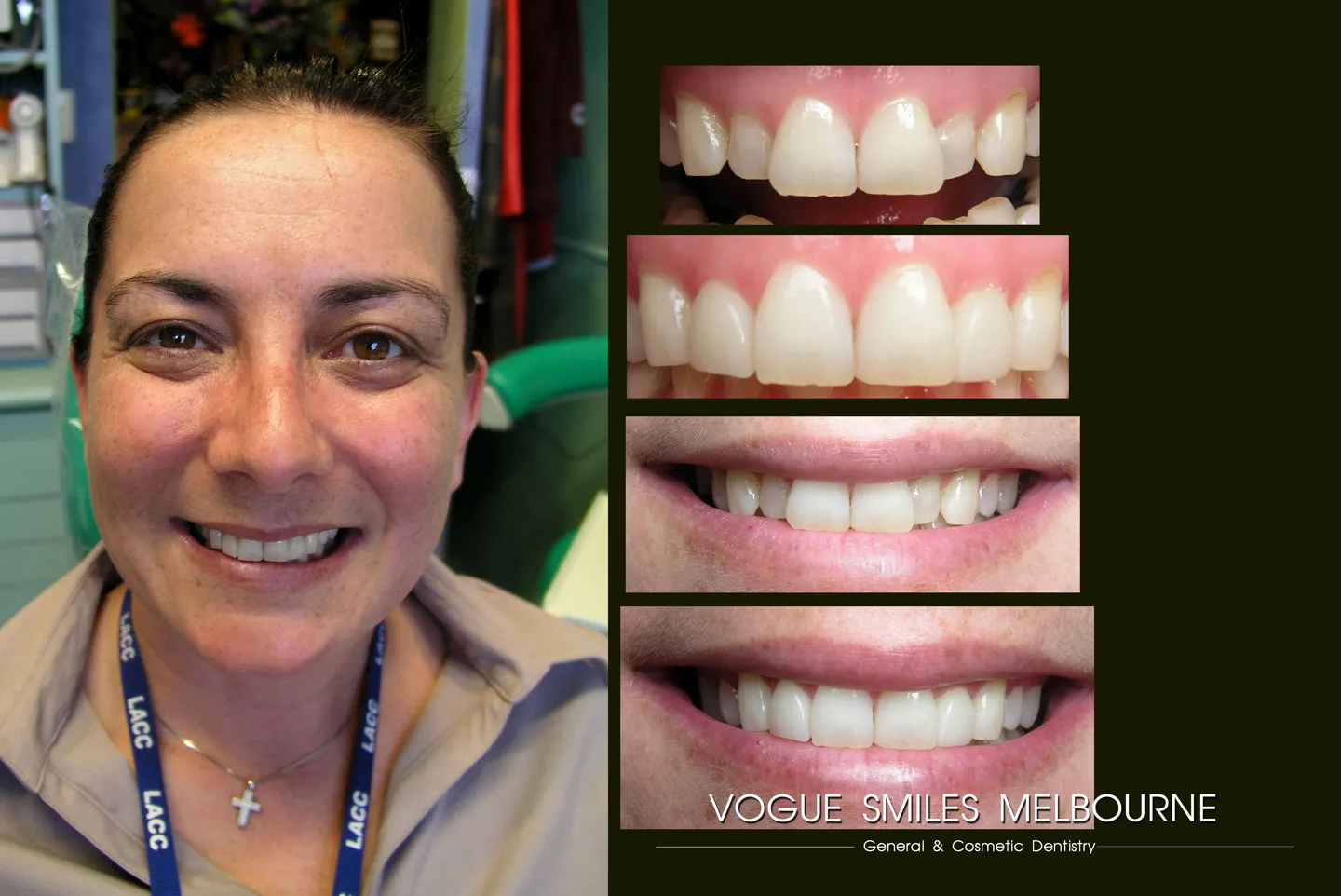 Porcelain Veneers for Crooked & Crowded Teeth Fix